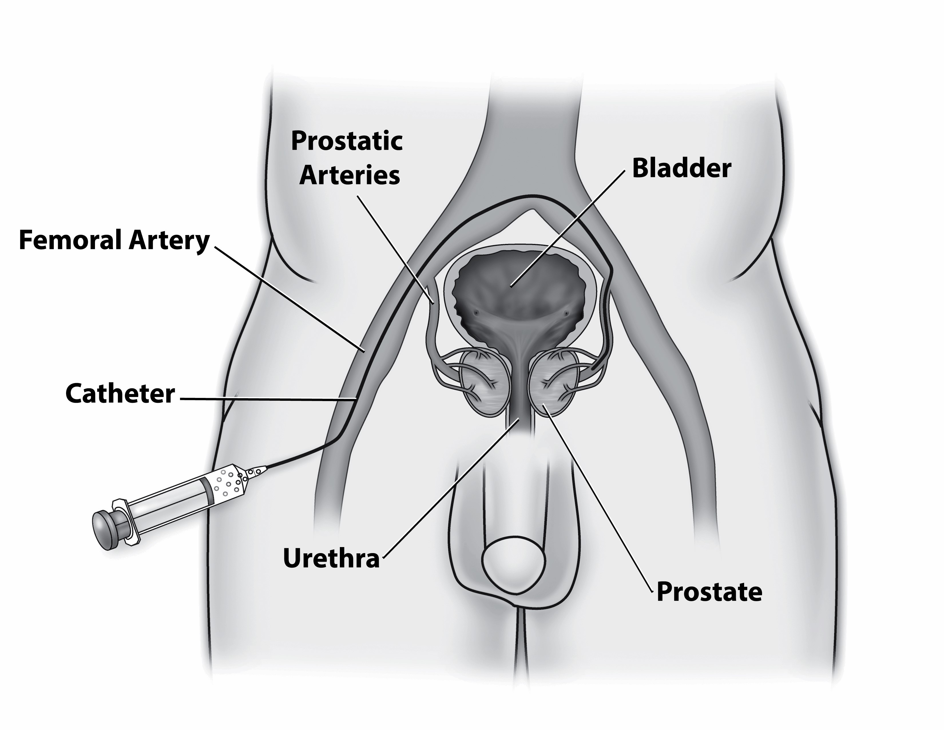 PAE Procedure Diagram